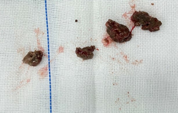 孩子脸部长歪了,孩子脸歪可以矫正吗