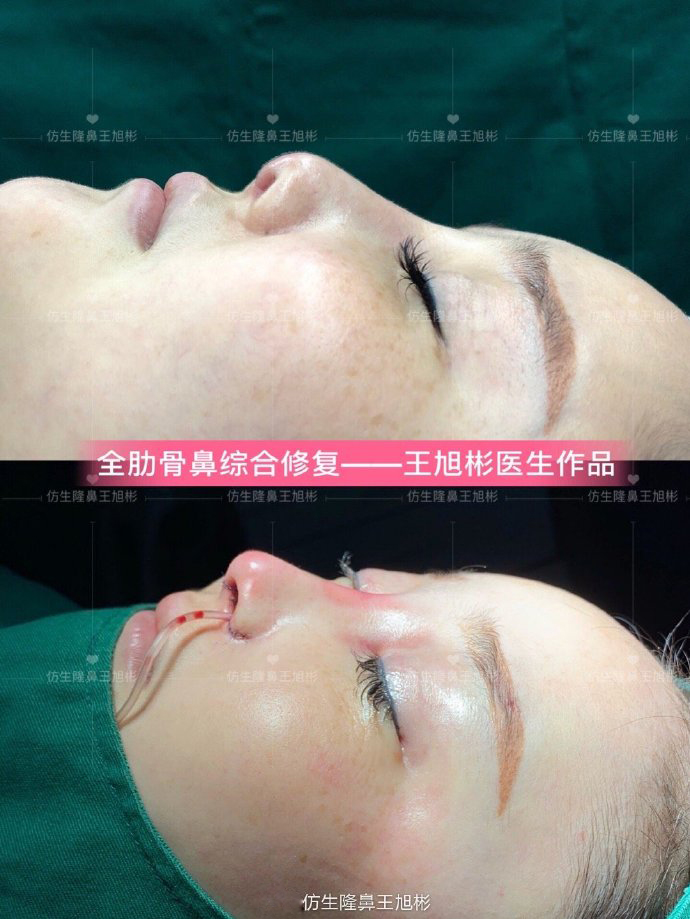 骨粉注射隆鼻皮肤变薄怎么办,线雕隆鼻会引起鼻挛缩吗