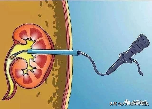 健康提醒:泌尿外科专家说,肾结石超0.6cm,就要及时治疗