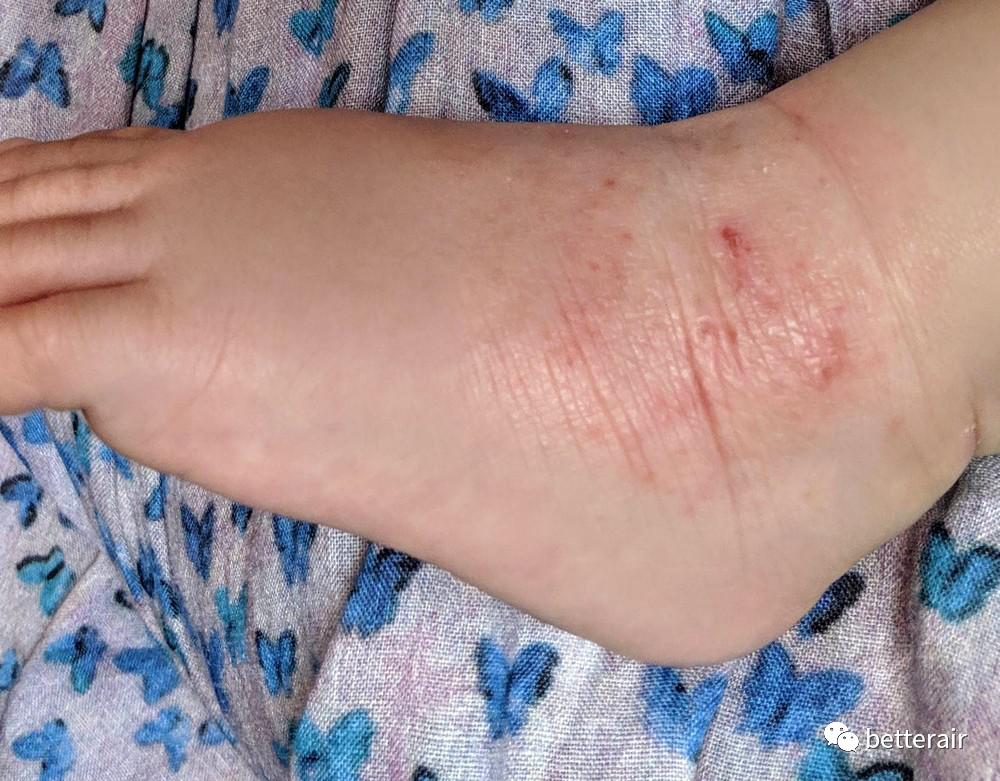 宝宝湿疹发作,痒痛到又哭又叫,直到betterair出现