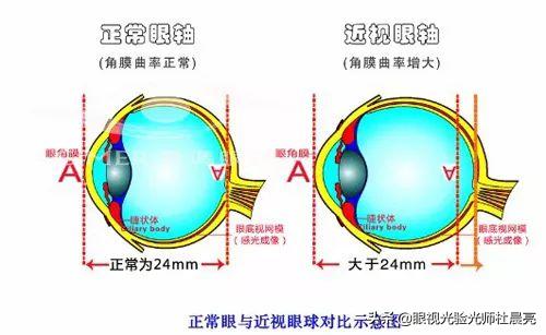 高度近视如何缓解眼球疲劳,高度近视的人眼睛有什么异样