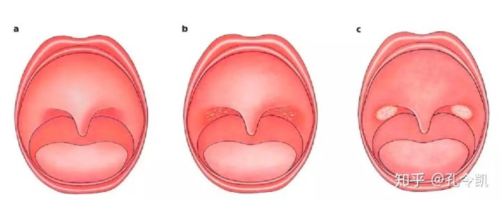 喂奶方式不正确宝宝会呛奶吗,喂奶方法不对会肠胀气吗