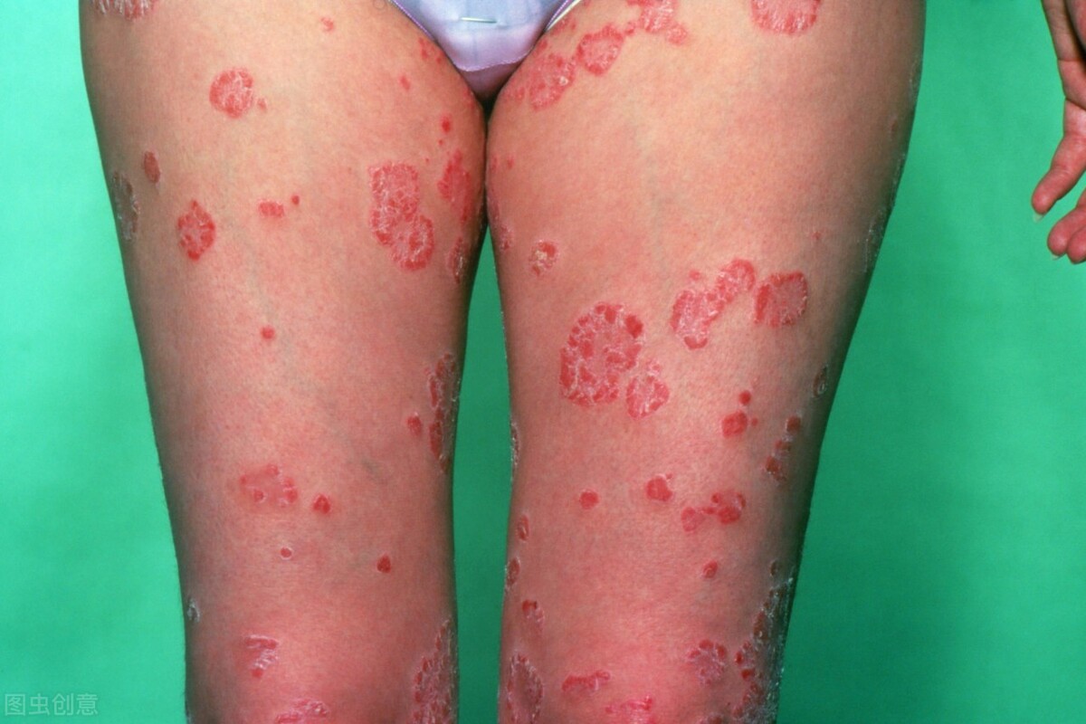 皮肤保湿，在银屑病的治疗过程中非常关键！2个方面一定要做到