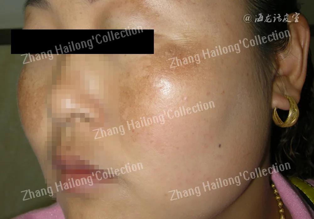 褐斑治疗,褐斑怎么办