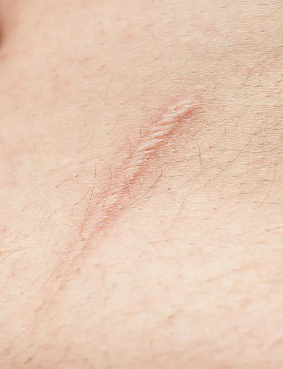 怎么避免不留疤,要怎样不留疤