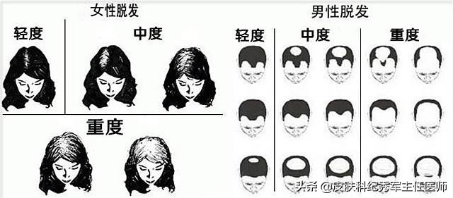 雄激素脱发有治好的案例吗 (雄激素脱发可以逆转吗)