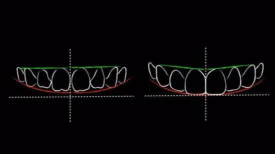 瓷贴面微笑的力量,局部瓷贴面