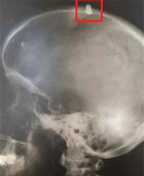 他被*弹子**击中额头，误以为是石子，跑完52里后，不料还有意外收获