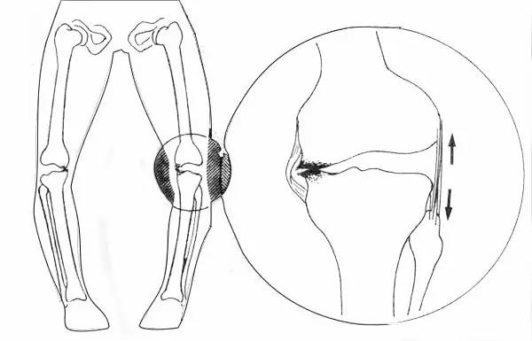 17岁xo型腿能矫正过来吗,x型腿o型腿能矫正吗