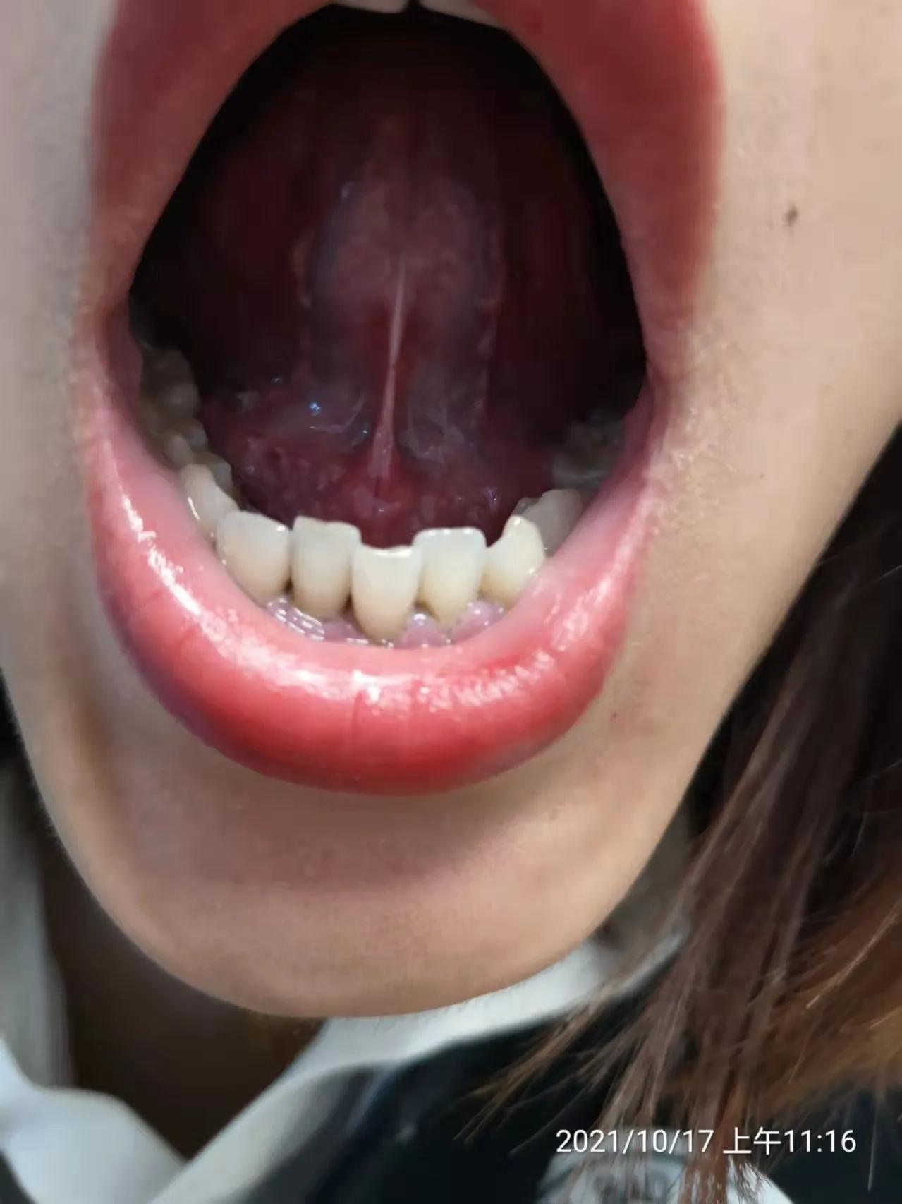 中药治疗多囊卵巢综合征案例,专治多囊卵巢闭经中成药