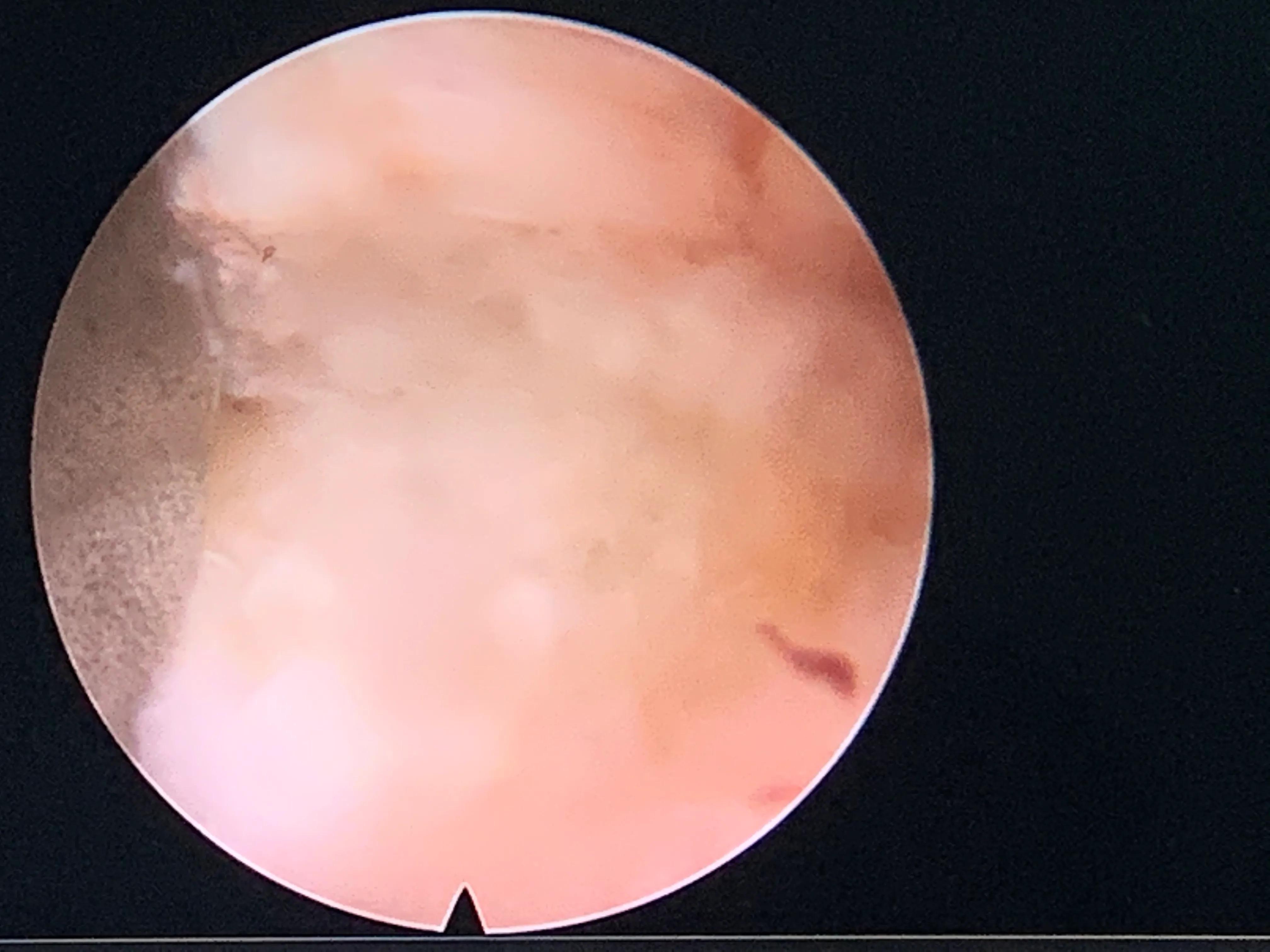 椎间孔镜术后腰痛症状多久消失,盘源性腰痛手术后易复发吗