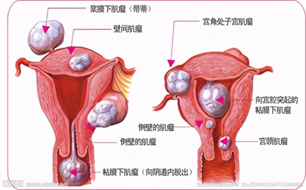 子宫肌瘤切除好还是不切除,子宫肌瘤切不切有什么影响