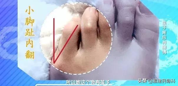 健康之路茧子,cctv10健康之路在线直播回看