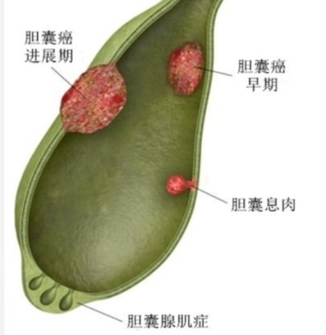 胆结石胆囊息肉不切除怎样治疗,胆囊息肉为什么不做保胆