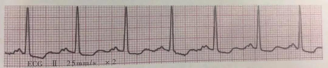 常见20种异常心电图及处理,常见20种异常心电图及特点