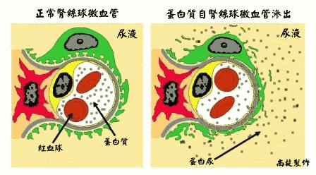 尿里蛋白质是指蛋白尿吗,蛋白尿的含义