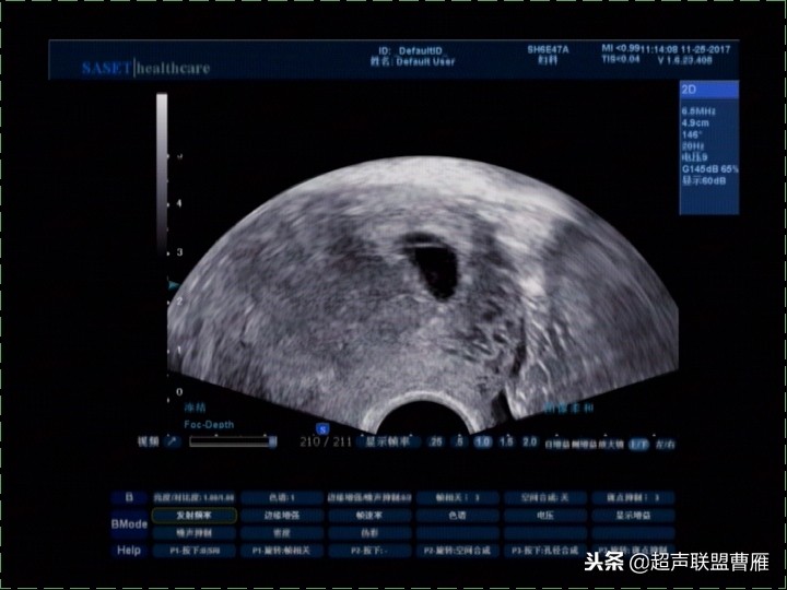 3毫米卵黄囊未见胎芽正常么,40多天的卵黄囊