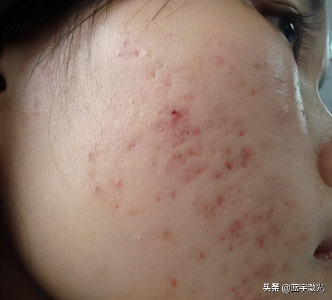 雀斑激光去除效果视频,雀斑激光祛除