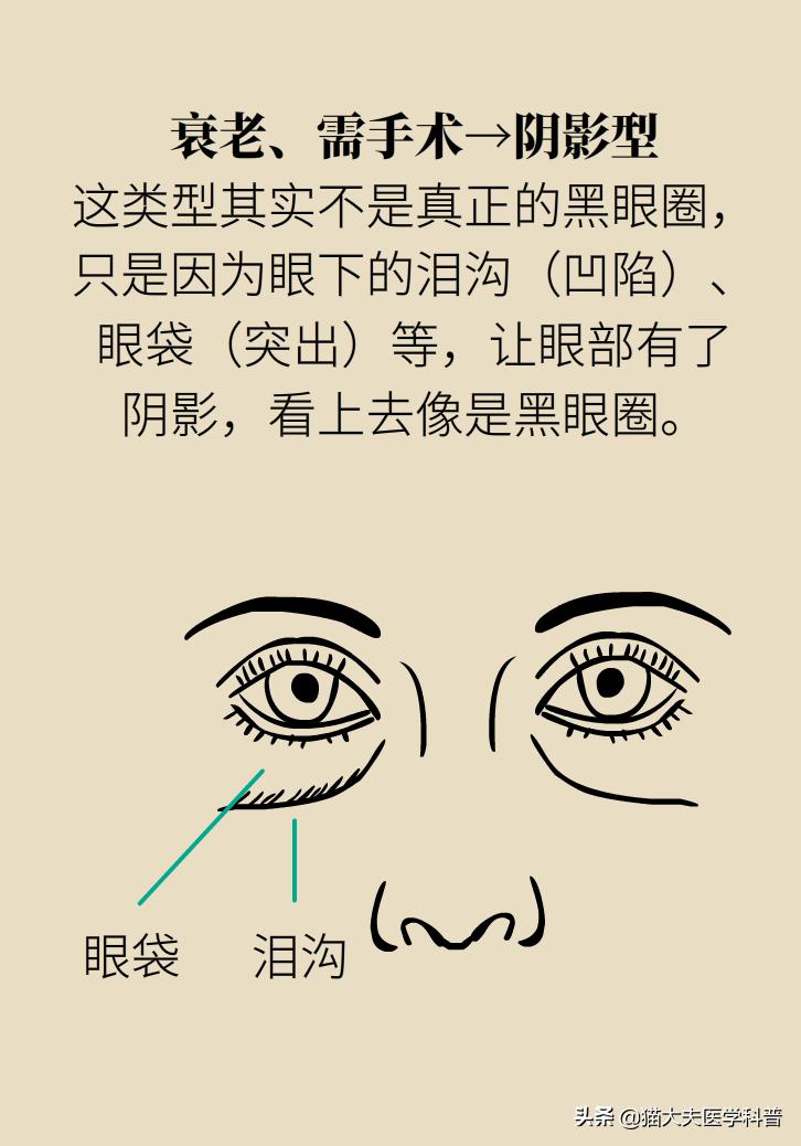 医生黑眼圈,手术消除黑眼圈靠谱吗