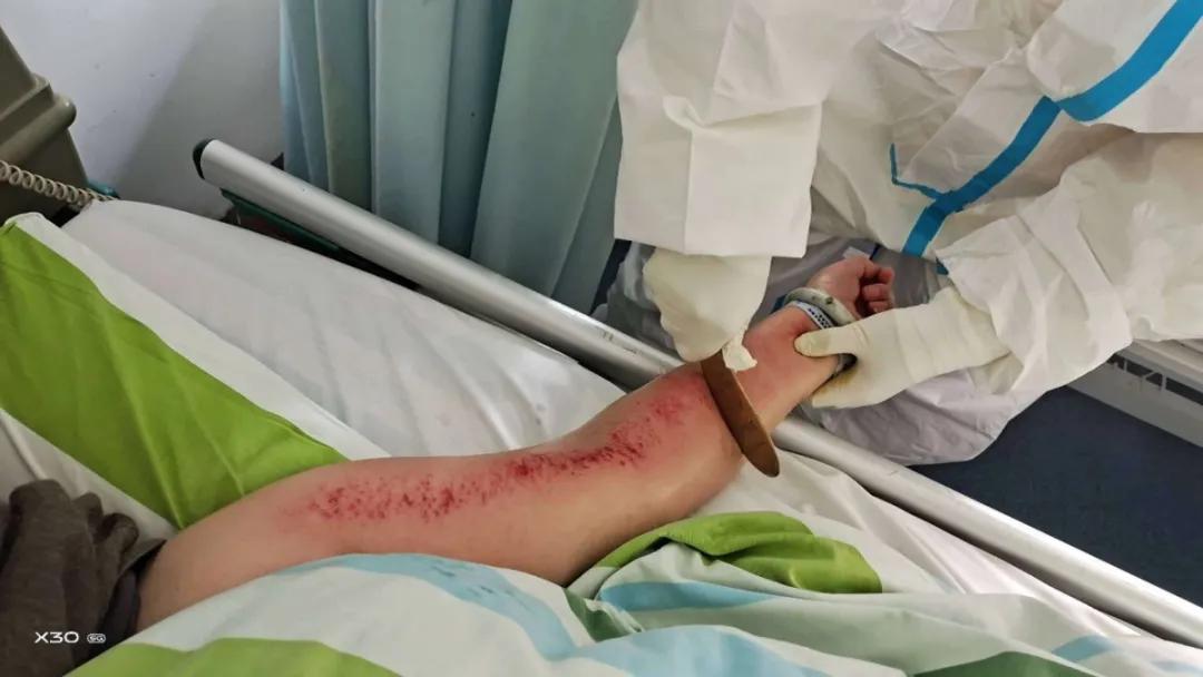 中医特色护理技术走红武汉战“疫”前线|一线日志