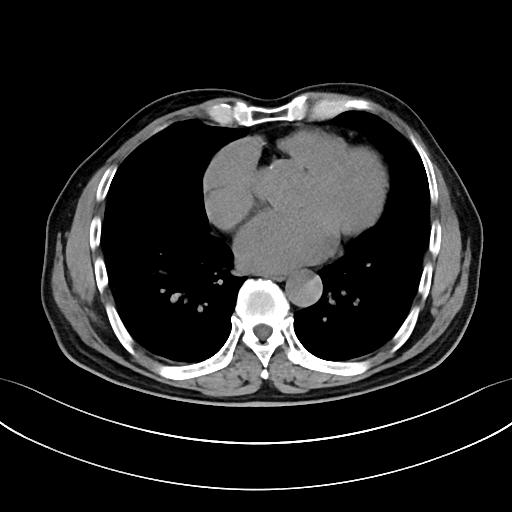 胸部Ct平扫能查出主动脉夹层吗,主动脉夹层cta影像图片解读