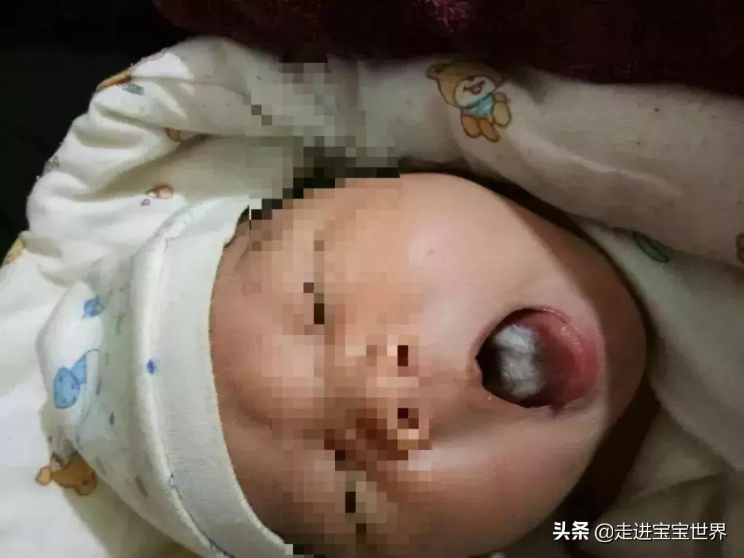 积食引起的舌苔白厚怎么办,小儿积食舌苔白厚吃啥药