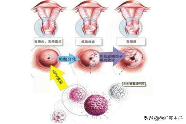 宫颈癌的致病元凶,宫颈癌的罪魁祸首图片