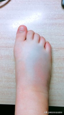 产后手脚浮肿是什么原因,手脚面部浮肿是什么原因