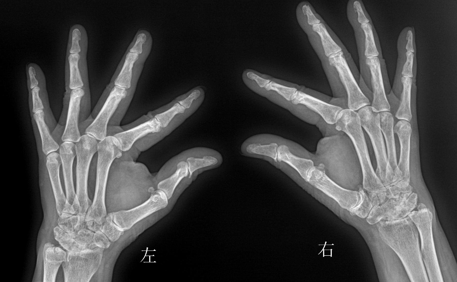 类风湿关节炎早期发现治疗能好吗,早期类风湿关节炎彻底治愈率