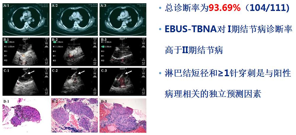 全球对肺癌治疗的最有效最新技术,肺癌的支气管镜介入治疗