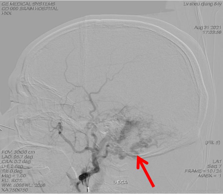 耳鸣4年，四处求医未果，这次治好了