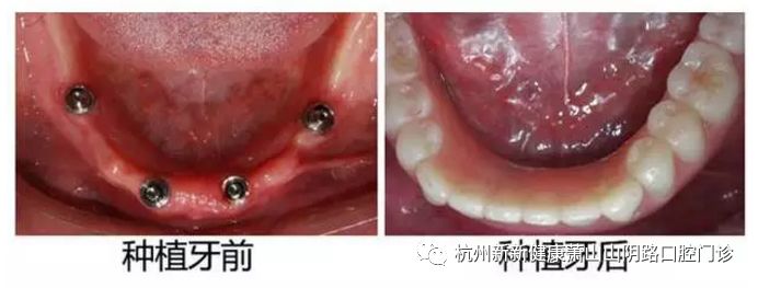 半口即刻负重种植牙过程详细步骤,即刻种植牙怎样修复牙齿的