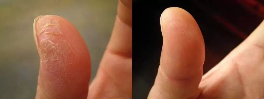 冬天脚跟干裂又起皮怎么办,冬天脚跟干裂起硬皮擦什么保湿好