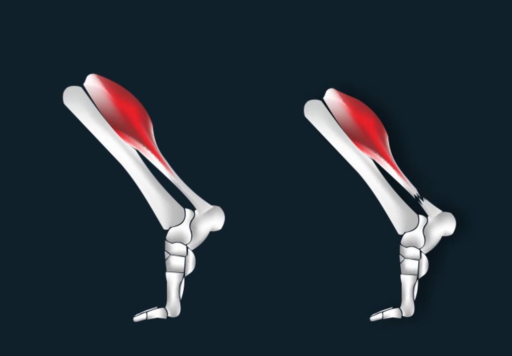 跑步引起的跟腱炎怎么矫正,跑步的隐患