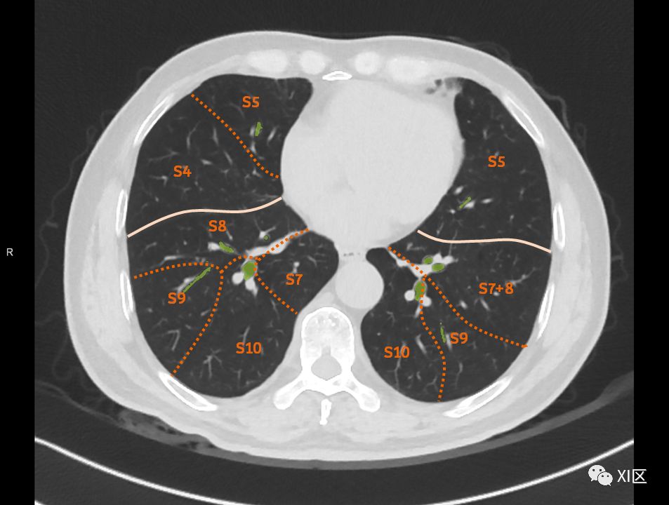 如此详细的肺部影像解剖，有点儿酷