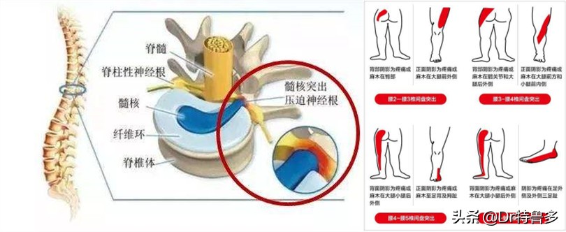 大腿内侧痛，胯也痛...有根神经被卡住了