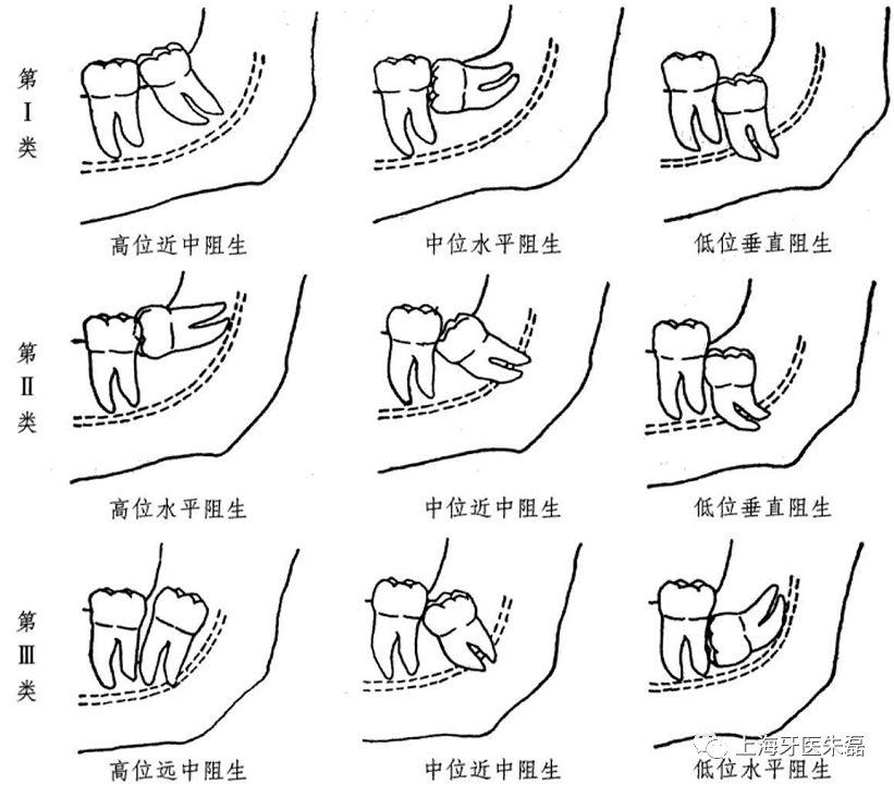 埋伏水平阻生智齿拔掉风险,阻生智齿拔掉后多久能吃硬的东西