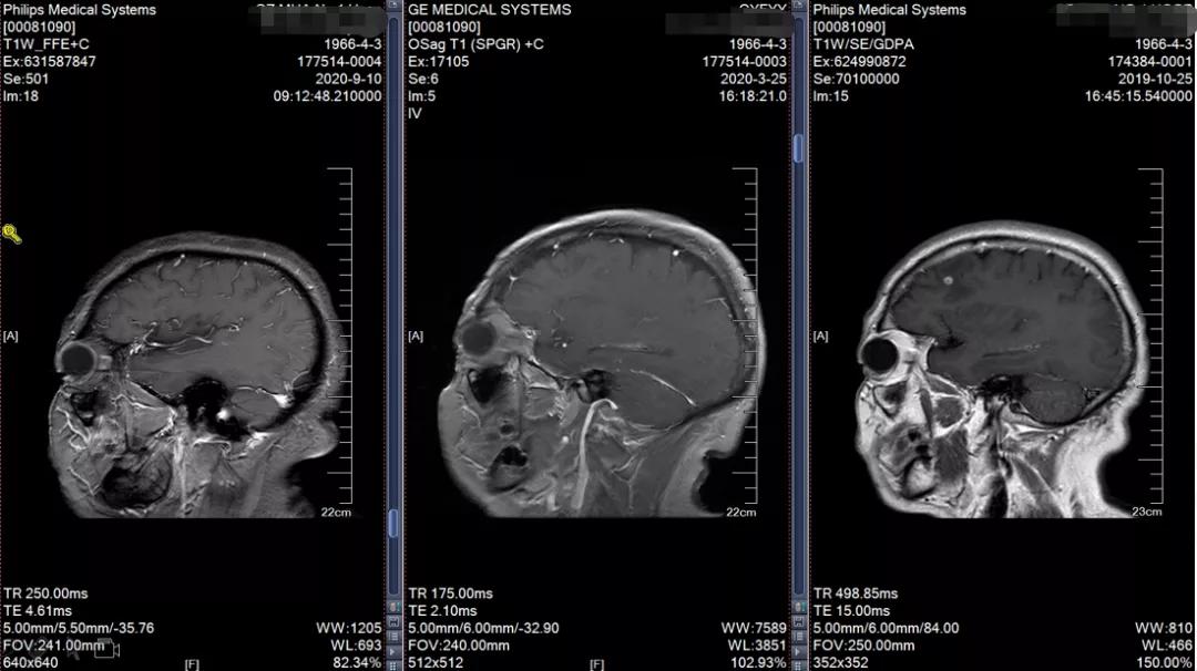 肺癌晚期可以靶向加免疫治疗吗,肺癌晚期化疗加免疫治疗有效吗