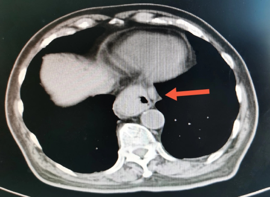 贲门癌吐血抢救,中国最著名的贲门癌治疗专家