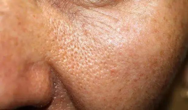 毛孔粗大真实修复对比,毛孔粗大拯救全过程