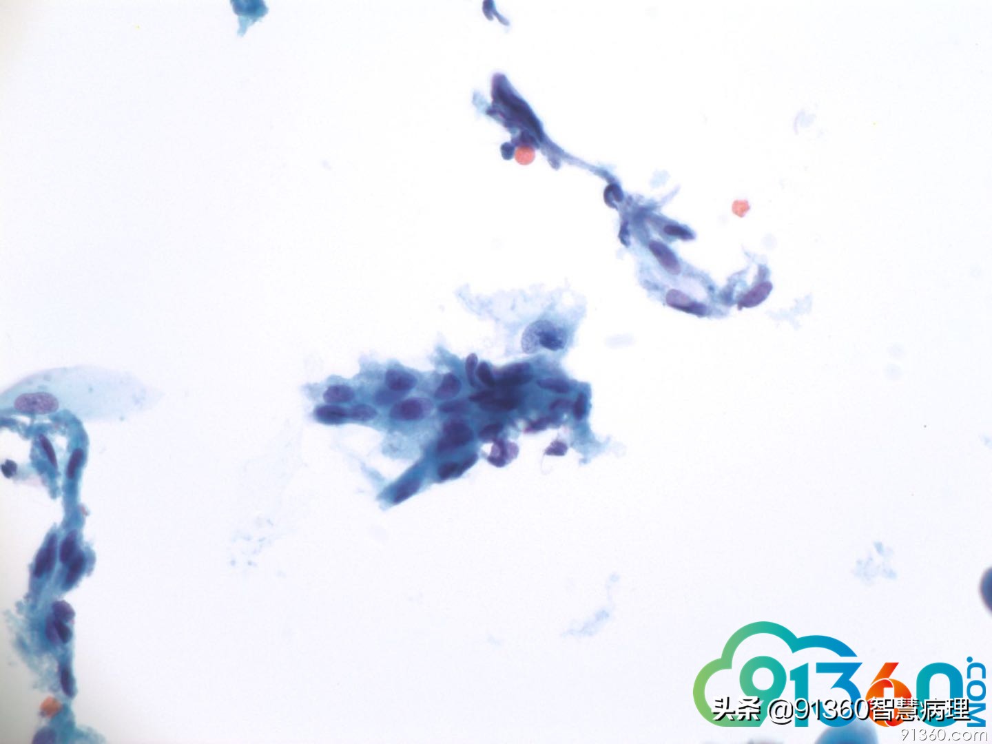 宫颈病理tct是什么检查,tct出现ascus会是宫颈癌吗