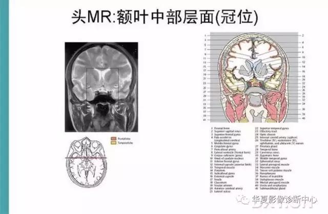 电子版头颅ct与mri断层解剖,头颅mri血管解剖与分段详解