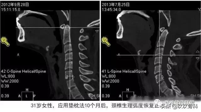 颈椎病治疗的十大误区,颈椎病4大治疗误区你知道吗