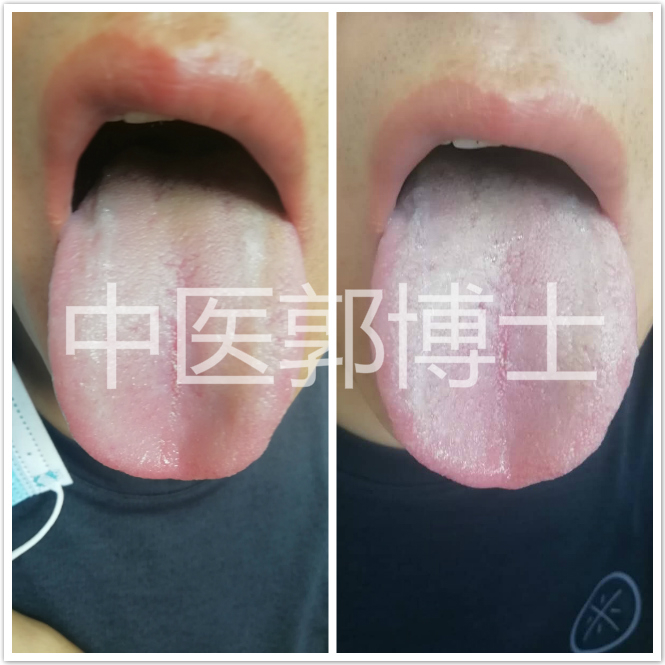 头颈部汗多怎么缓解,头面多汗是什么原因