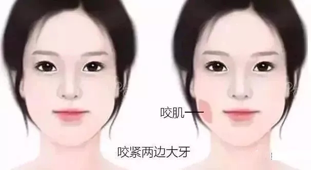 溶脂针和瘦脸针哪个有效点,溶脂针和瘦脸针一起打有副作用吗