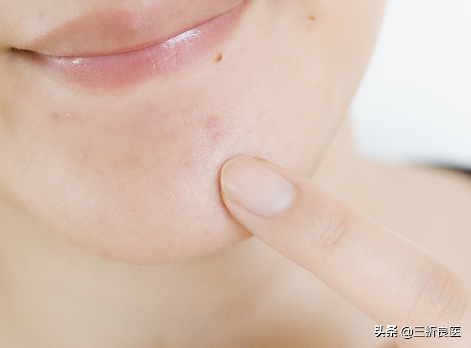 皮肤科医生痘印怎么解决,皮肤科医生推荐淡化痘印