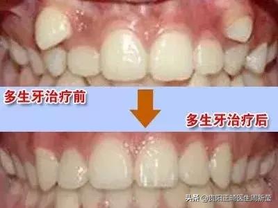 长了多生牙但是把恒牙给拔了,长了多生牙拔除疼吗