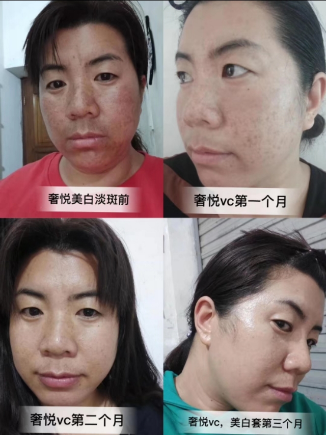 奢悦美白淡斑套盒正品,奢悦美白淡斑套盒200元