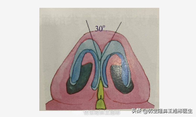 大鼻头能做直鼻微翘吗,可以只做鼻头缩小术吗