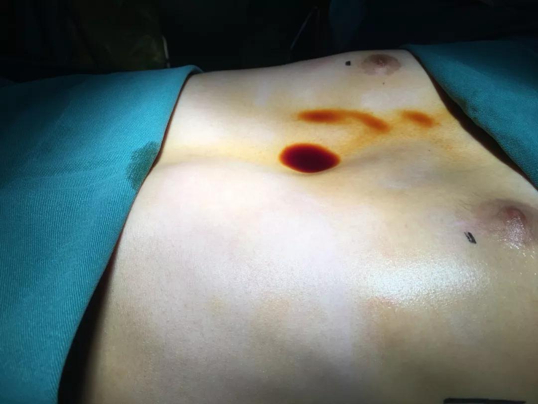 14岁男孩因“漏斗胸”自卑想退学，这是种什么病？